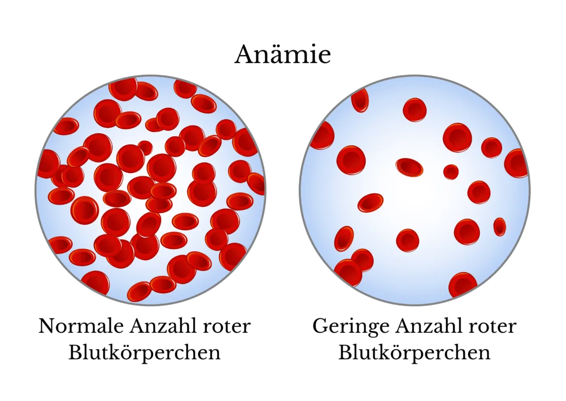 Anämie