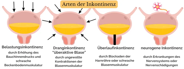 Arten von Inkontinenz Arten der Inkontinenz