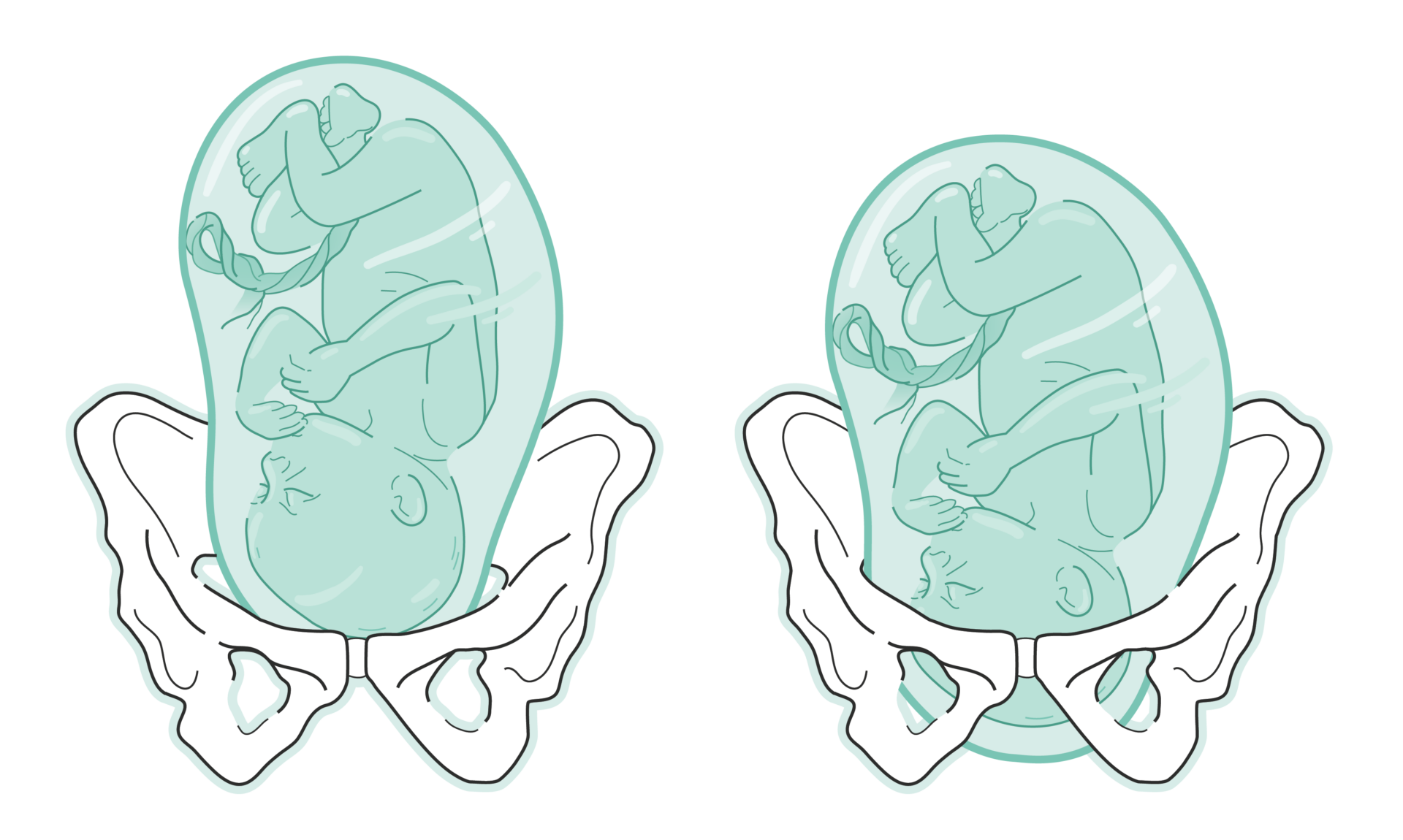 Blasensprung - Geht Jetzt Die Geburt Los?