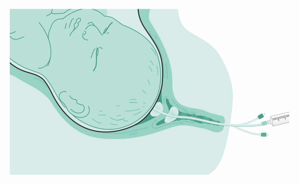 Cervical balloon 1 Geburtseinleitung mit dem Ballonkatheter