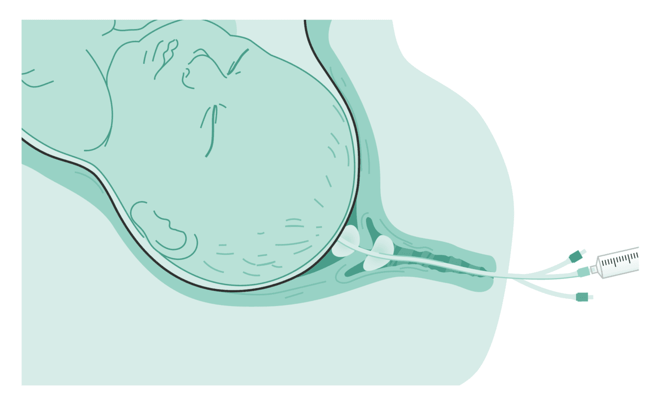 Cervical balloon Ballonkatheter mechanische Methode zur Geburtseinleitung