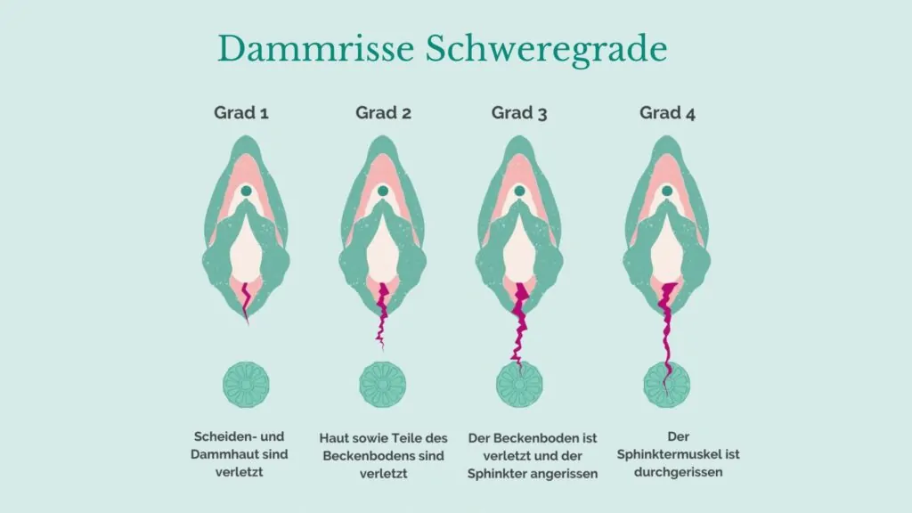 Dammrisse Schweregrade Geburtsverletzungen Dammrisse
