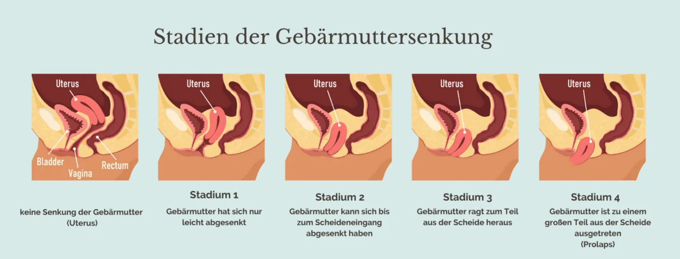 Gebaermuttersenkung stadien Stadien Gebärmuttersenkung