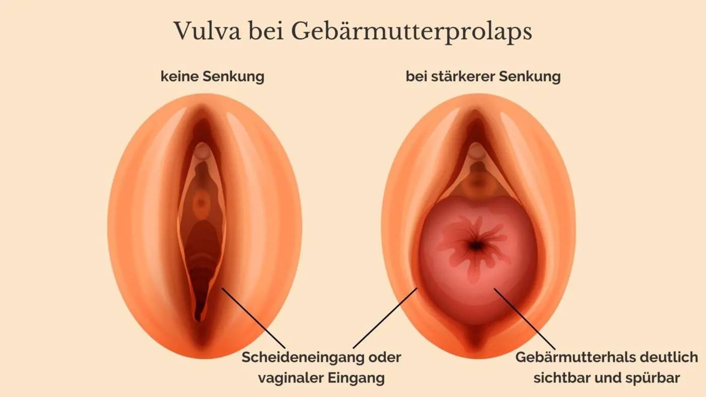 Gebaermuttersenkung vulva Gebärmutterprolaps Vulva