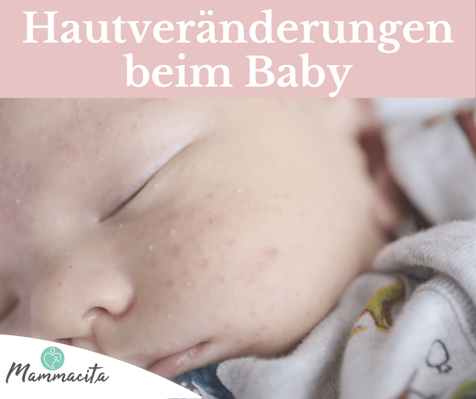 Milchschorf Neugeborenenakne Und Andere Hautveranderungen Beim Saugling Mammacita