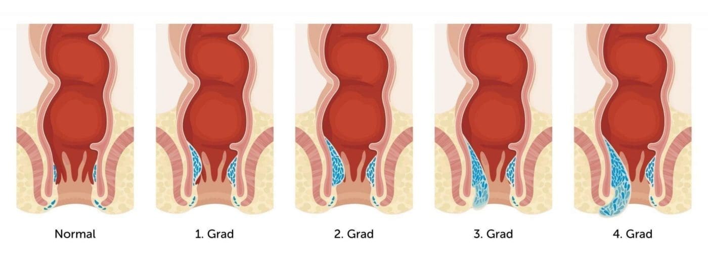 Haemorrhoiden in der Schwangerschaft Schweregrade