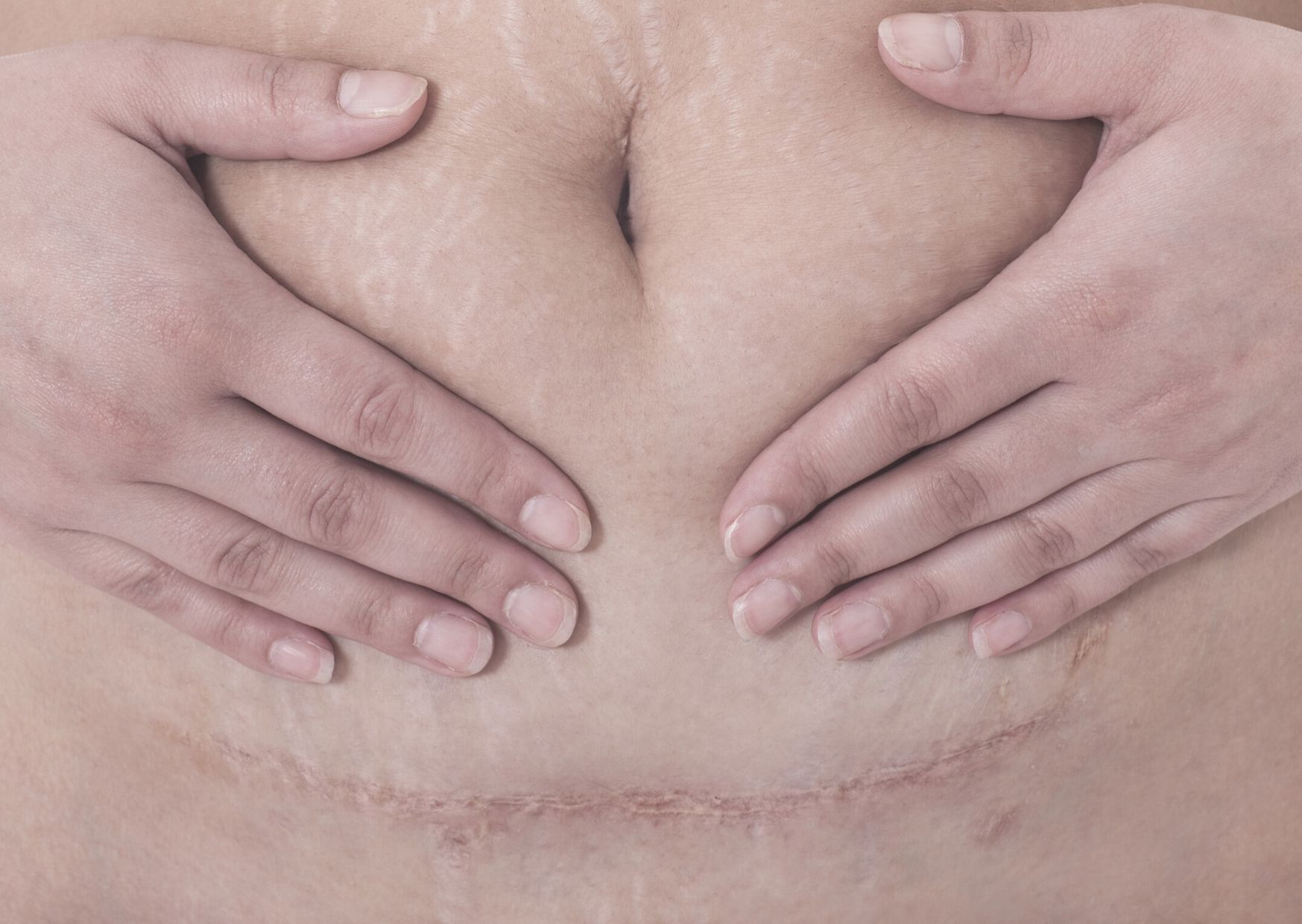 Kaiserchnittnarbe Kaiserschnittnarbe