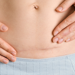 Artikel aus der Kategorie Kaiserschnitt