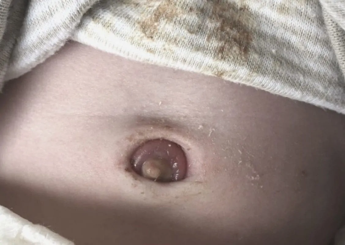 Nabelgranulom Bauchnabel entzündeter bauchnabel bei baby