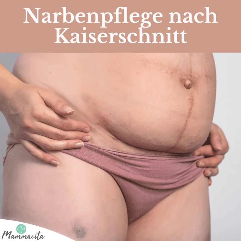 Narbenpflege: Der richtige Umgang mit der Kaiserschnittnarbe