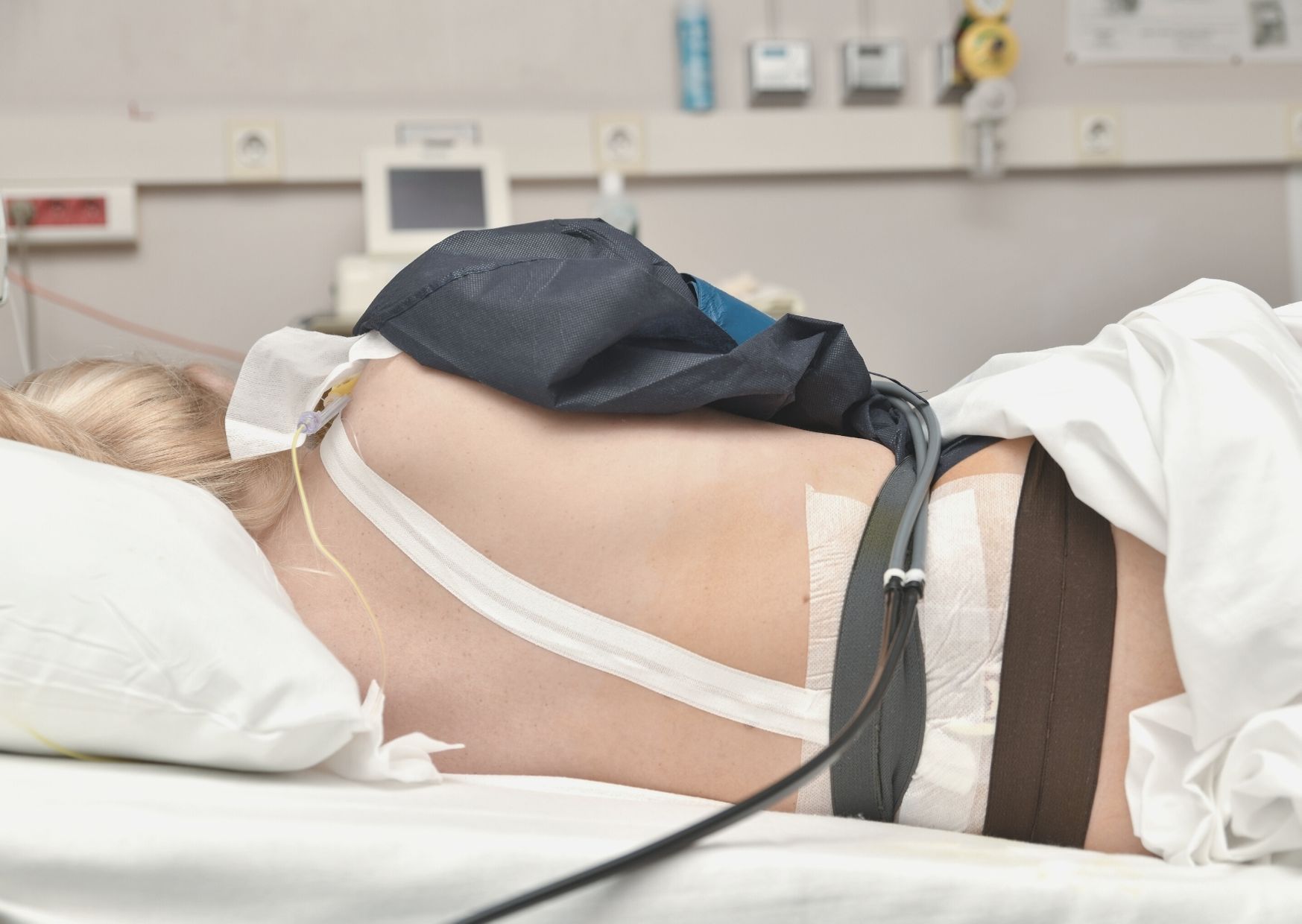 PDA bei Kaierschnitt Peridualanäthesie Kaiserschnitt