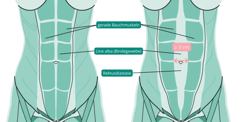 Rektusdiastase nach Schwangerschaft 4 Rektusdiastase