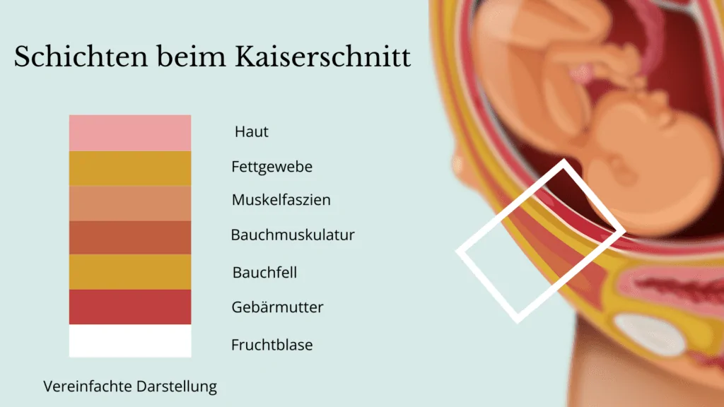 Schichten Kaiserschnitt 7 Schichten beim Kaiserschnitt