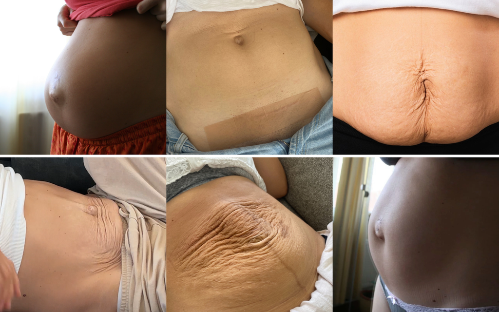 So sieht en Bauch nach Geburt aus so sieht der Bauch nach der Geburt aus