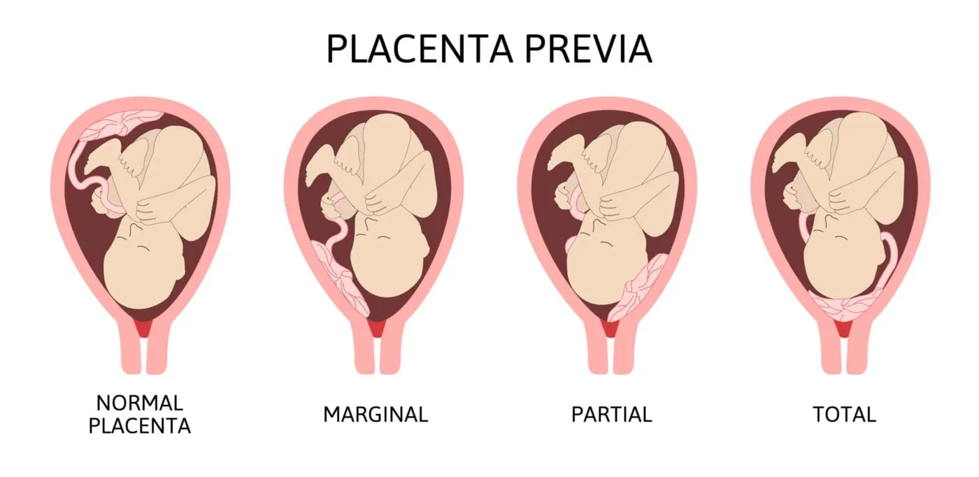 Verschiedene Palzentapositionen scaled Plazenta Praevia, tiefer Sitz der Plazenta