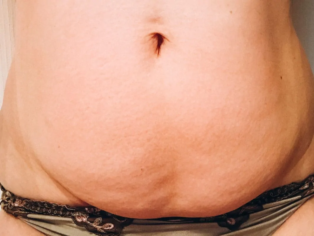 kaiserschnitt bauch bleibender Postnatalbauch
