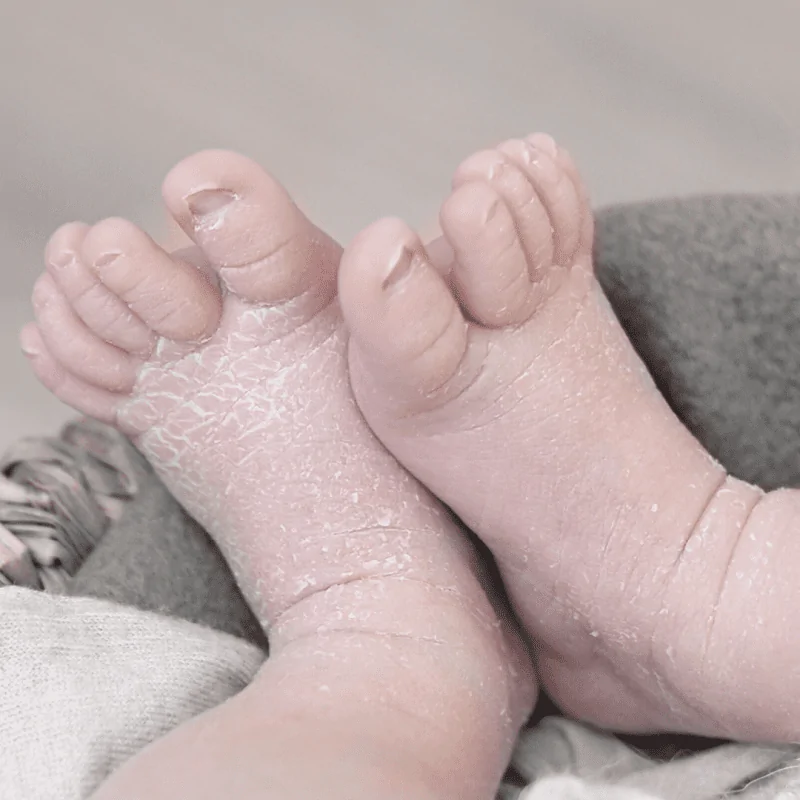 trockene Haut Baby trockene-Haut-Baby