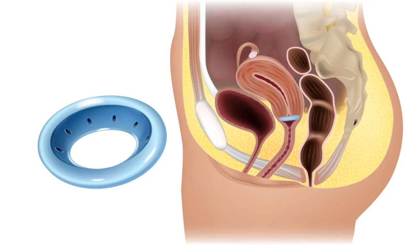 vagiales Pessar vaginales Pessar Beckenbodenschwäche